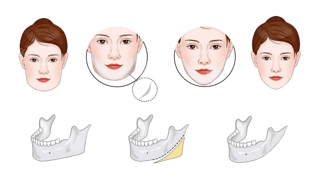 顴骨內(nèi)推加下頜角截骨多少錢