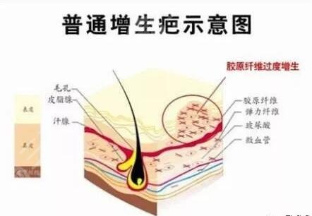 腹壁整形疤痕