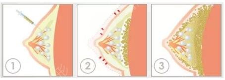 深圳美萊郭杰脂肪填充案例