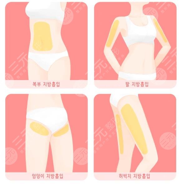 全身抽脂可以保持多久？