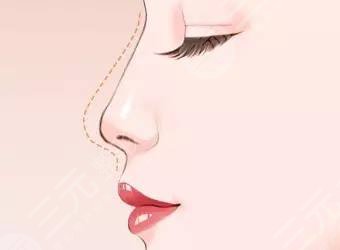 隆鼻
