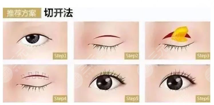 上海于景浩雙眼皮修復(fù)案例參考