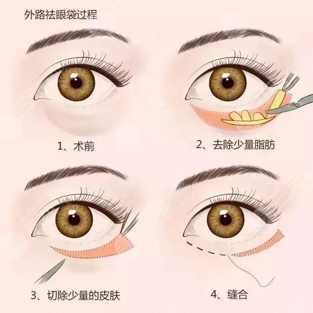 眼袋外切手術是什么