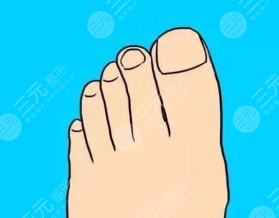 腳趾縮短手術
