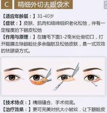 上海長(zhǎng)征醫(yī)院整形美容科去眼袋案例