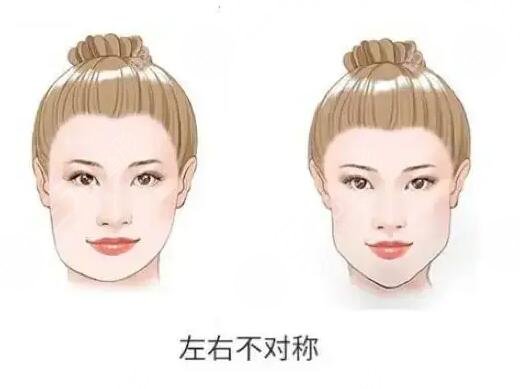 下頜骨一高一低臉歪怎么矯正？左右臉不對(duì)稱能矯正過來嗎？