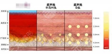 半島黃金超聲炮和超聲炮的區(qū)別有哪些？