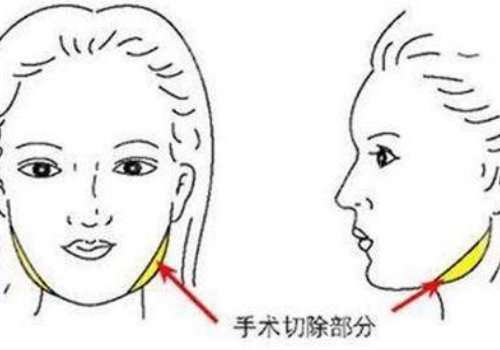 削骨三年后的真實(shí)案例