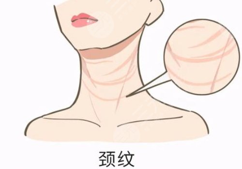 頸部皮膚松弛有什么辦法可以改良？