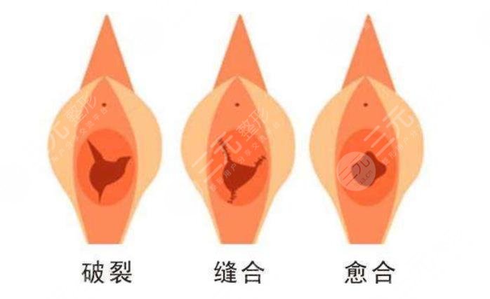 女性私密緊致手術(shù)后的改變好嗎