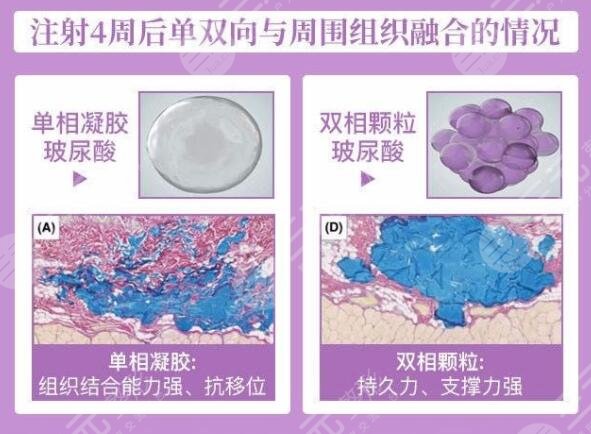 婕爾玻尿酸有后遺癥嗎？