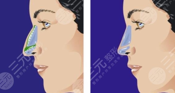 談宇騰做鼻子案例