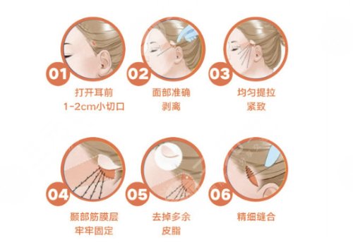 小切口拉皮手術費多少錢