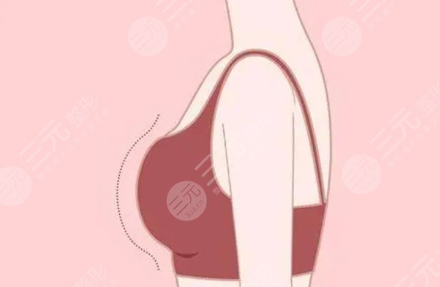假體