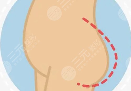 脂肪豐臀多久能恢復(fù)好？