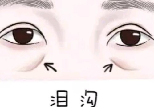 淚溝凹陷怎么解決好？