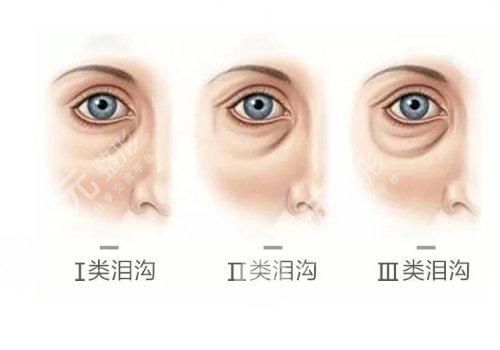 淚溝填充大概要多少錢？