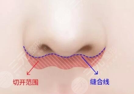 人中縮短