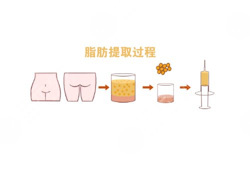 陳茂年修復(fù)的雙眼皮自然嗎