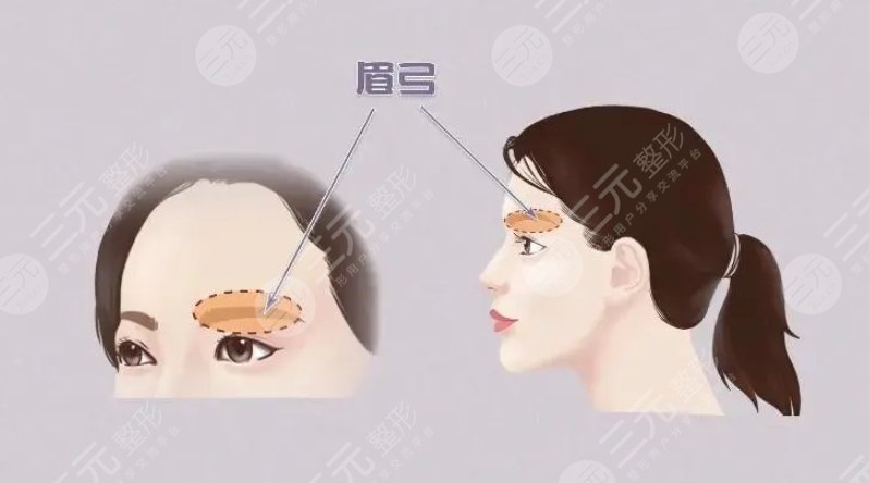 眉弓填充