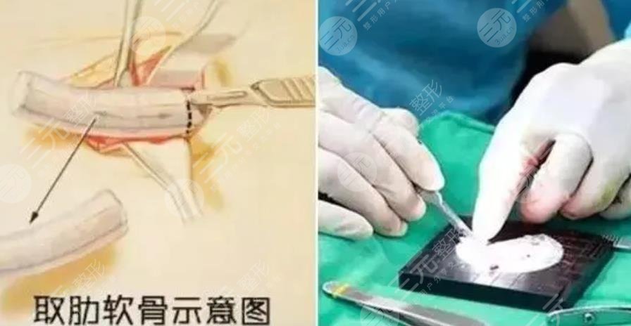 假體隆整形