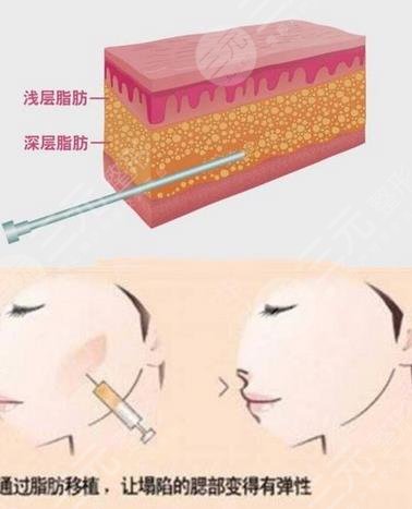 自體脂肪面部填充