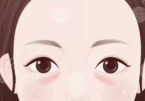 脂肪填充淚溝5到10天照片案例分享來啦