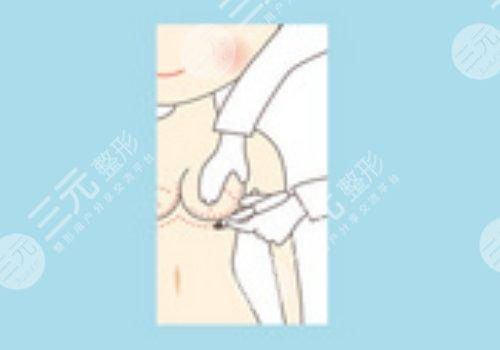 曼托假體好不好？