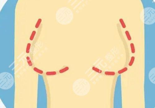 曼托假體好不好？