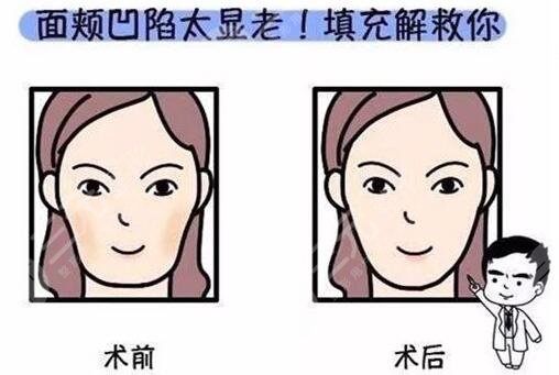 填充面部整形要多少錢？價格表匯總！3種常用材料對比，必看~