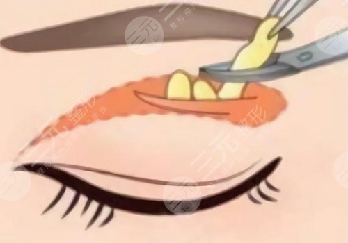 樸一飛醫(yī)生做雙眼皮怎么樣