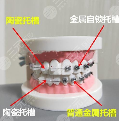 牙齒矯正
