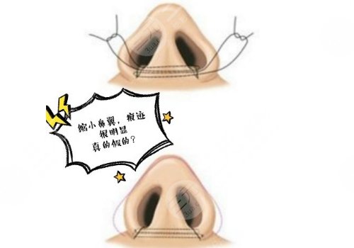 武漢同濟(jì)醫(yī)院鼻翼縮小案例圖