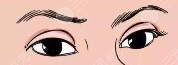 雙眼皮