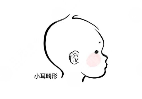 耳再造手術(shù)大概要多少錢？