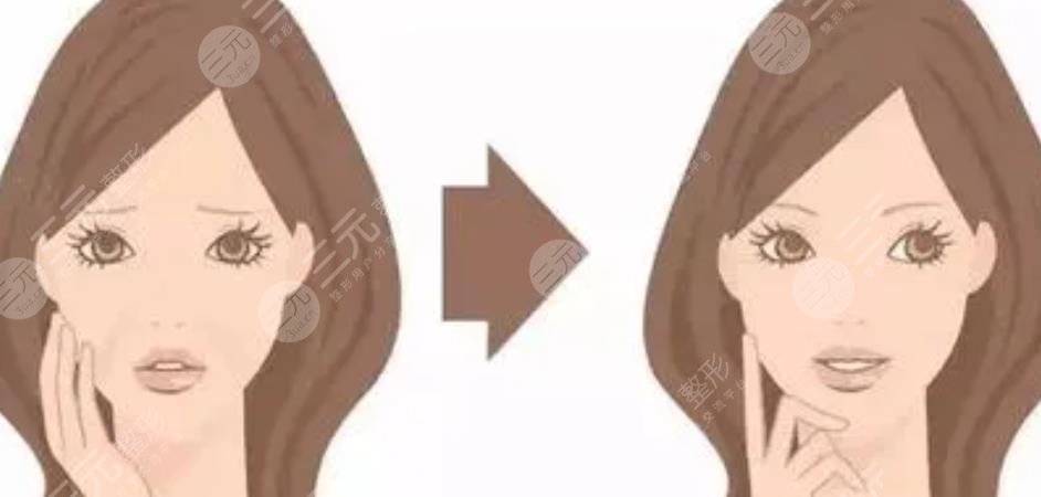 輪廓固定提升