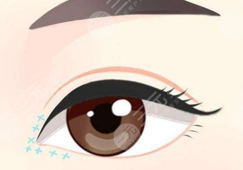 黃良飛雙眼皮修復(fù)怎么樣