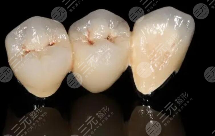 烤瓷牙