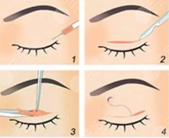 閆迎軍雙眼皮案例