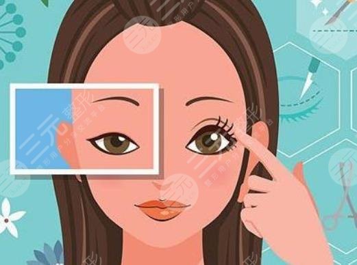 閆迎軍雙眼皮案例