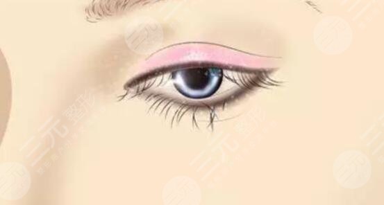 閆迎軍醫(yī)生雙眼皮案例