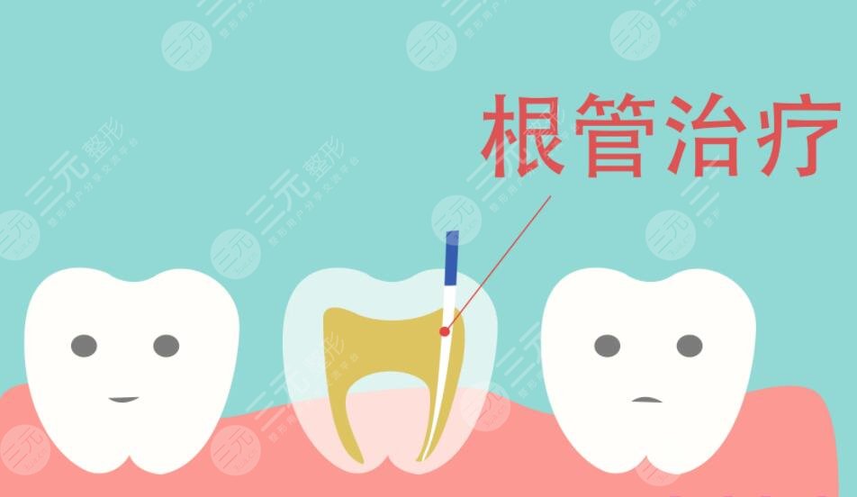 根管緩解