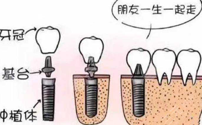 牙齒種植