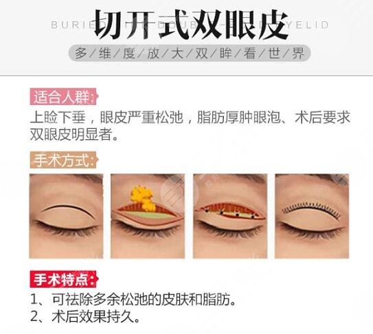 黃良飛雙眼皮修復(fù)科普分享