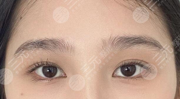 北京韓勛醫(yī)生雙眼皮修復(fù)案例分享