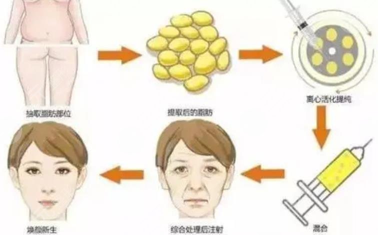深圳陽光醫(yī)院脂肪填充好嗎