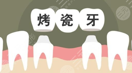 烤瓷牙