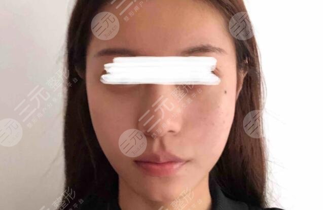 高亞東醫(yī)生拉皮手術(shù)案例真人分享~醫(yī)生態(tài)度及實(shí)力水平獲網(wǎng)友點(diǎn)贊！