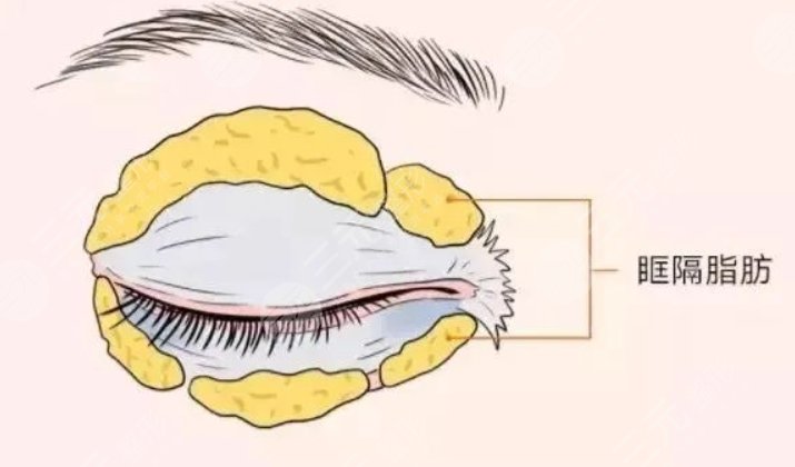 腫眼泡吸脂