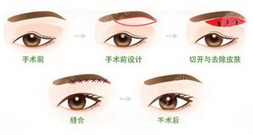 腫眼泡吸脂